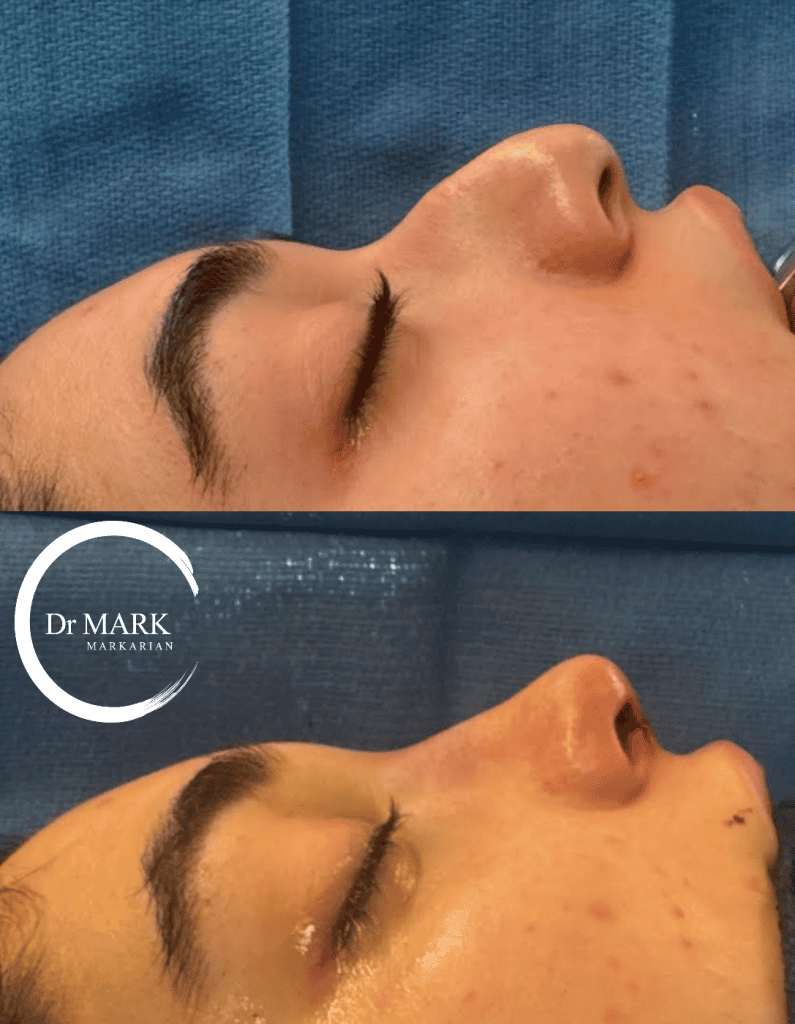 Female Rhinoplasty patient result 53
