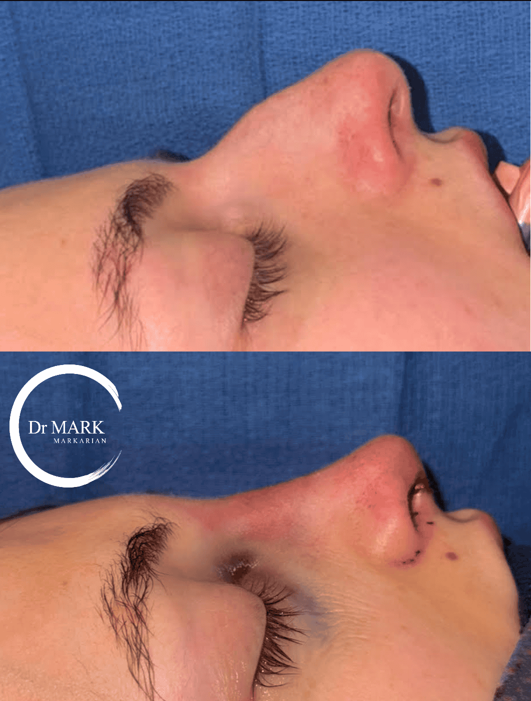 Female Rhinoplasty patient result 60