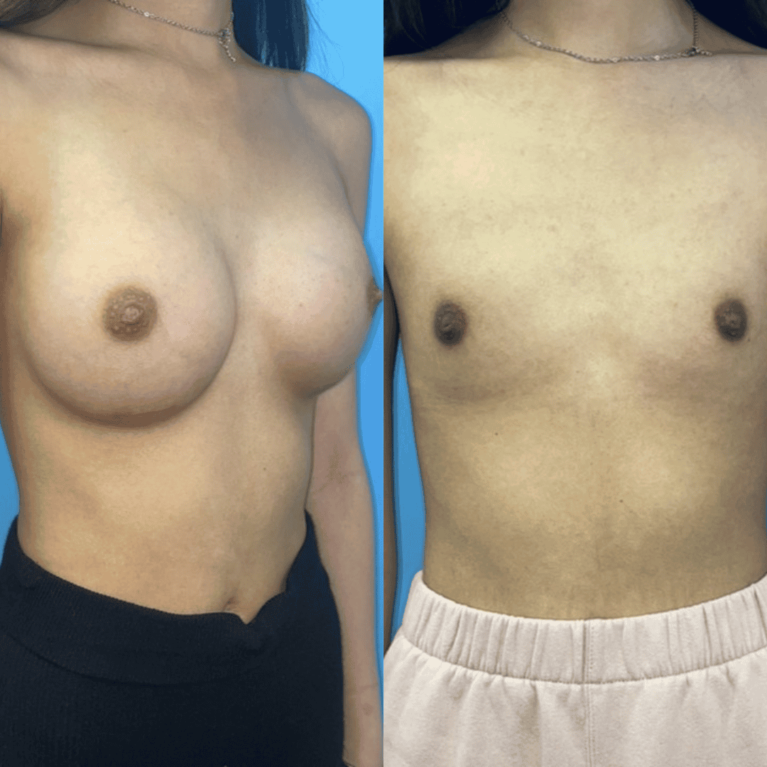 Beige Minimalist Skincare Before and After Instagram Post