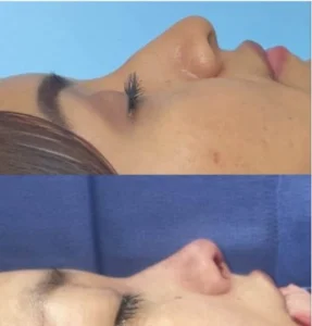 Rhinoplasty before and after image showing profile views of a patient's nose, immediate post-operative results