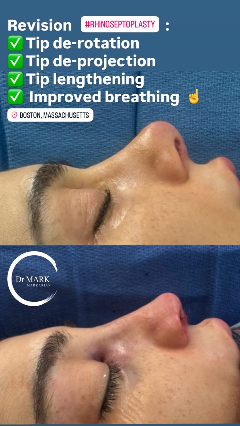 Immediately after a Rhino-Septoplasty