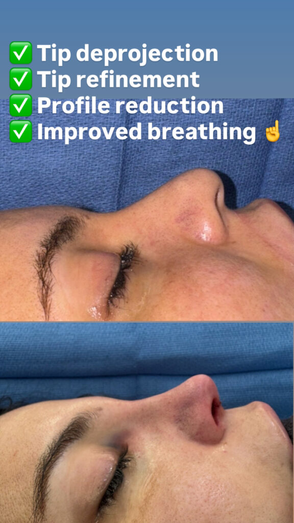 Immediately after a Rhino-Septoplasty
