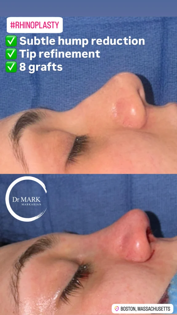 Female Rhinoplasty patient result 20