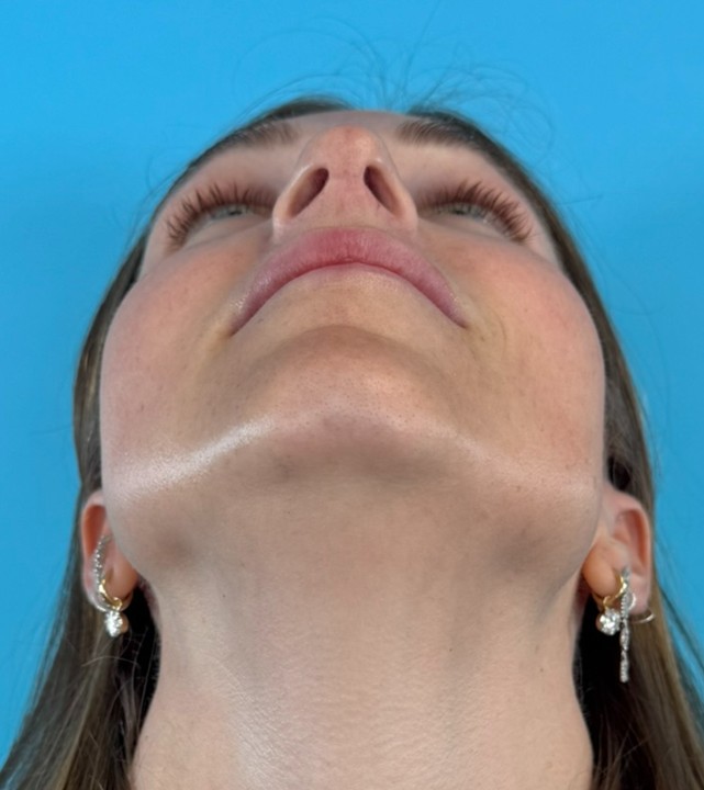 Rhino-Septoplasty