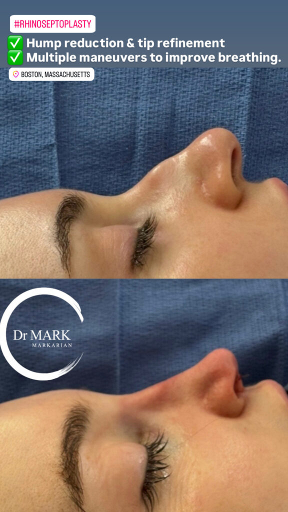 Immediately after a Rhino-Septoplasty