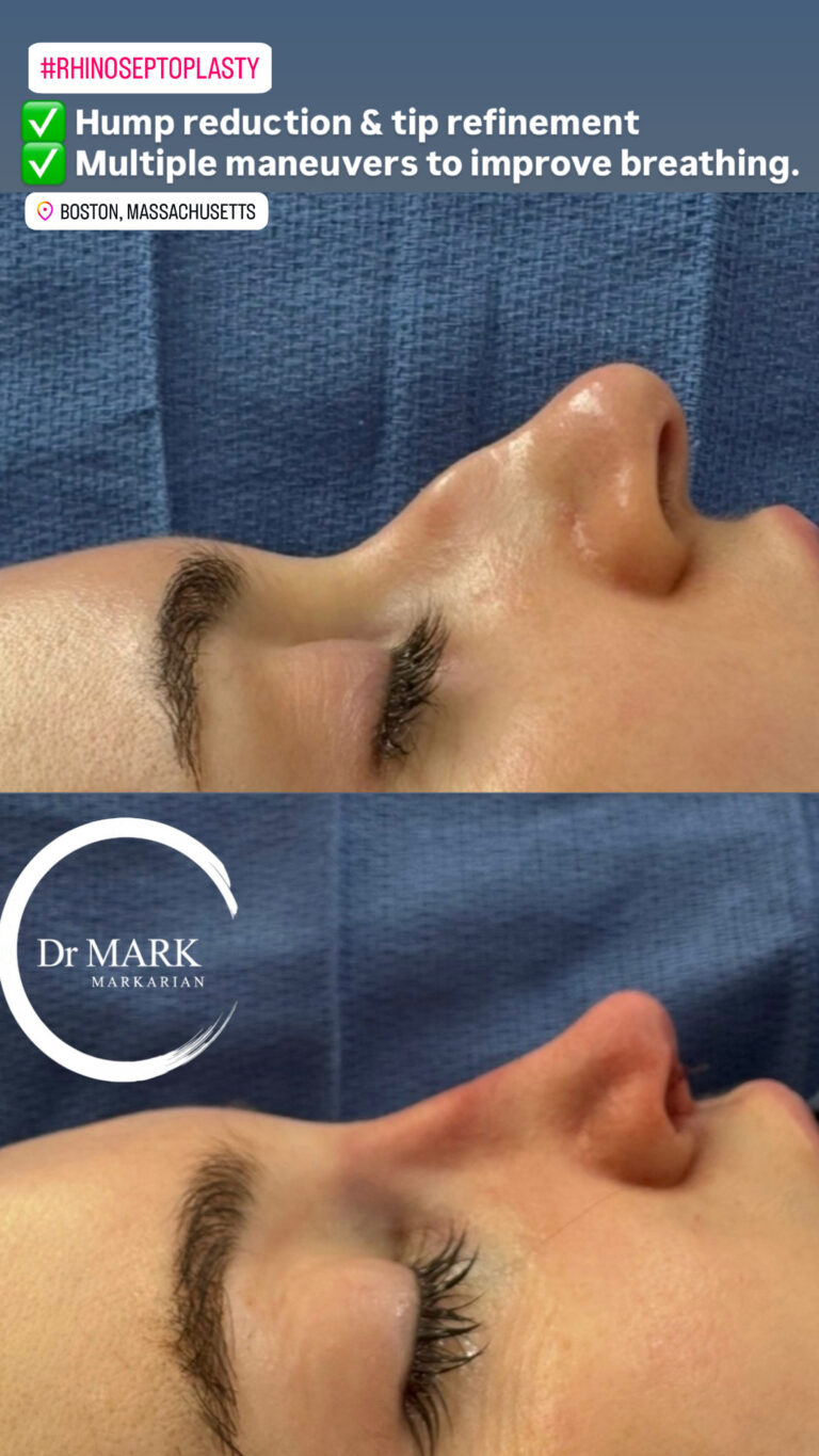 Immediately after a Rhino-Septoplasty