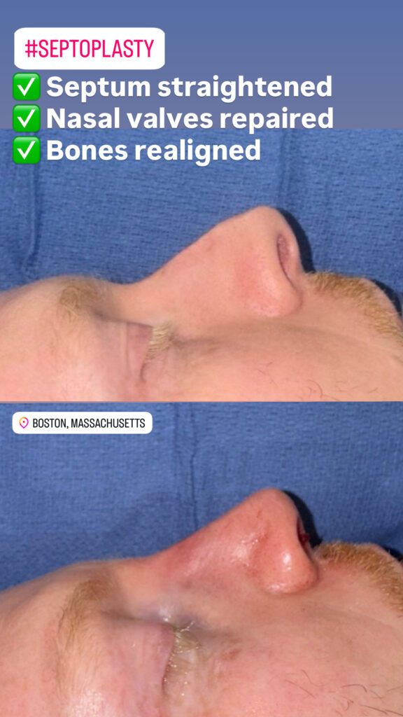 Immediately after a Rhino-Septoplasty