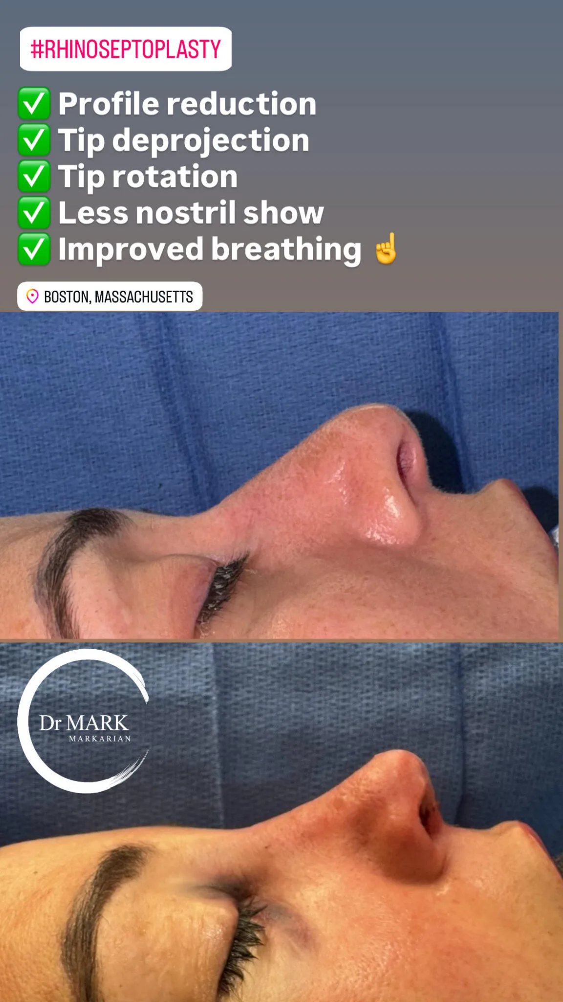Septoplasty before and after, Boston patient of Dr. Markarian, result 2