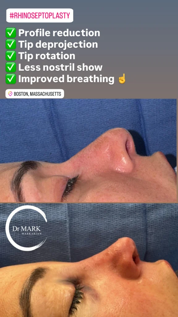 Female Rhinoplasty patient result 43