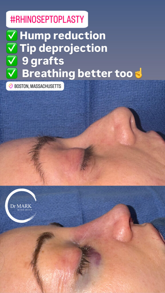 Immediately after a Rhino-Septoplasty