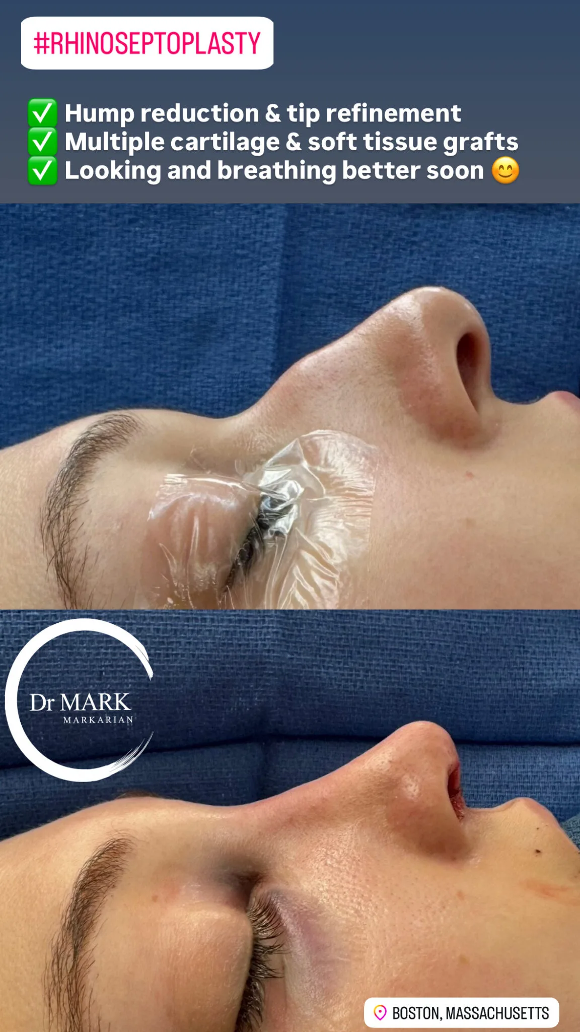 Septoplasty before and after, Boston patient of Dr. Markarian, result 8