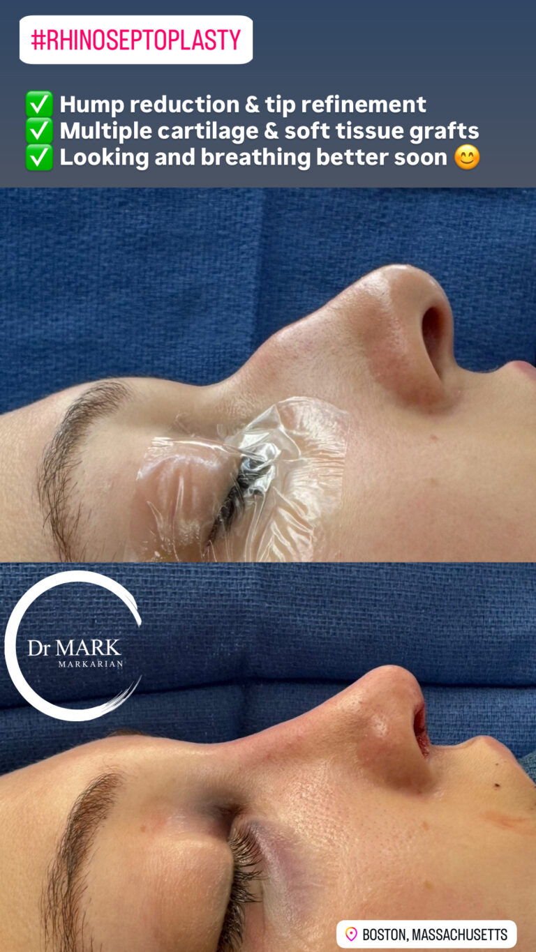Immediately after a Rhino-Septoplasty