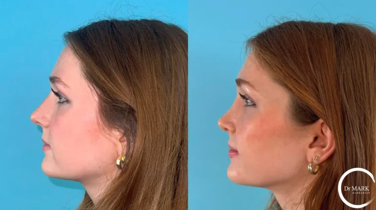 JG for insta - 1 year postop left lateral