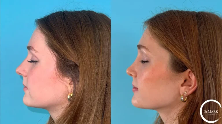 JG for insta - 1 year postop left lateral eyes closed