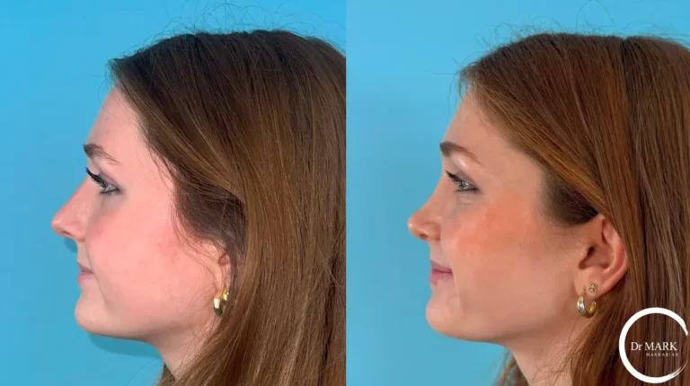 JG for insta - 1 year postop left lateral smiling
