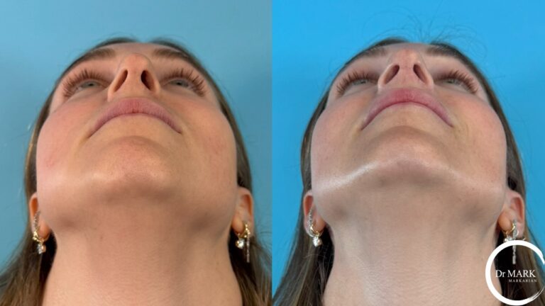 Rhino-Septoplasty