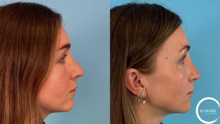 Rhino-Septoplasty