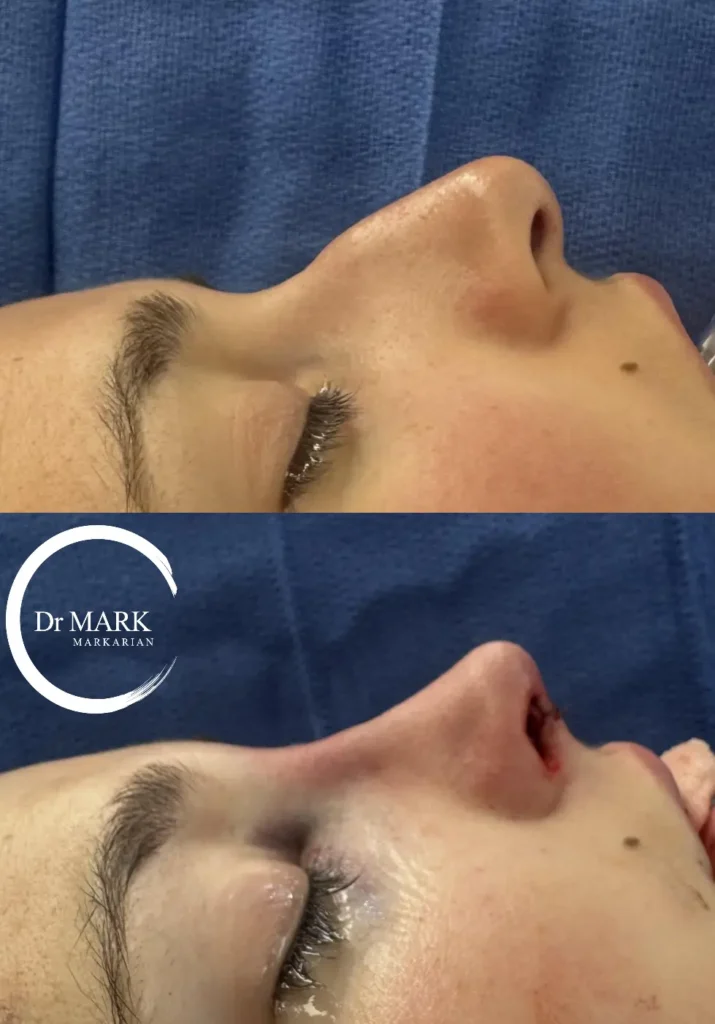 Immediately after a Rhinoplasty