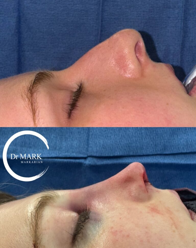 Immediately after a Rhino-Septoplasty
