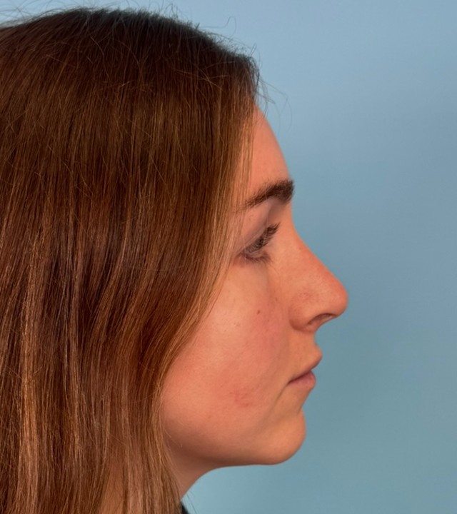 Rhino-Septoplasty