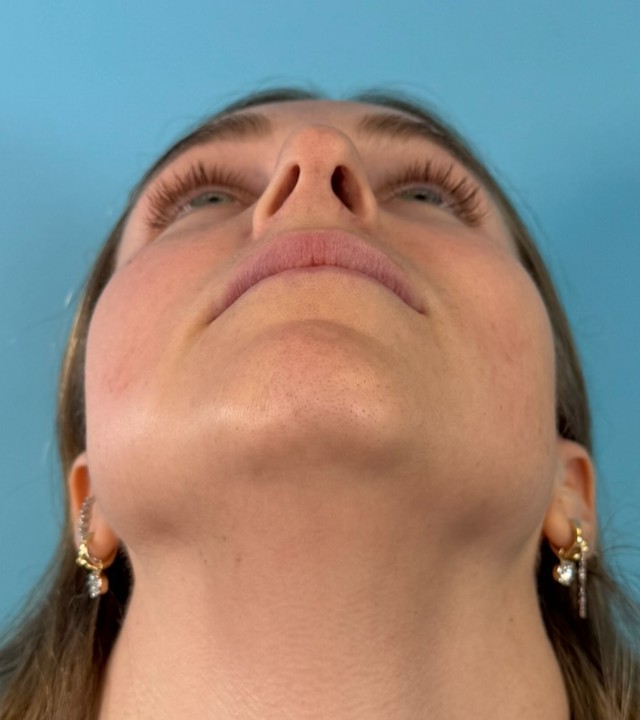 Rhino-Septoplasty
