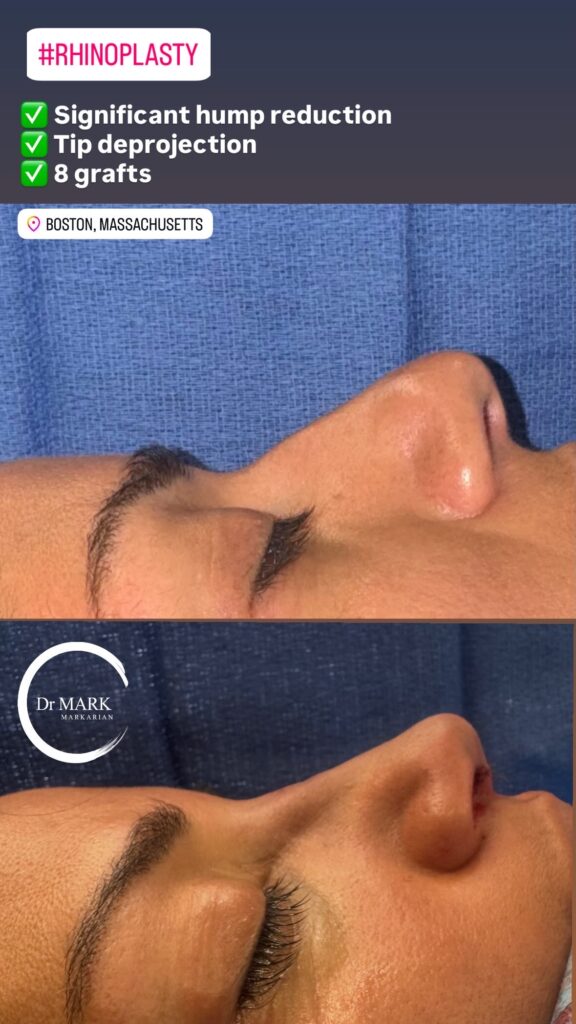 immediately after rhinoplasty