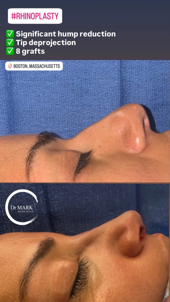 Female Rhinoplasty patient result 31