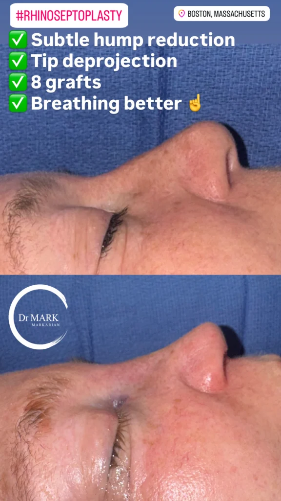 Female Rhinoplasty patient result 33