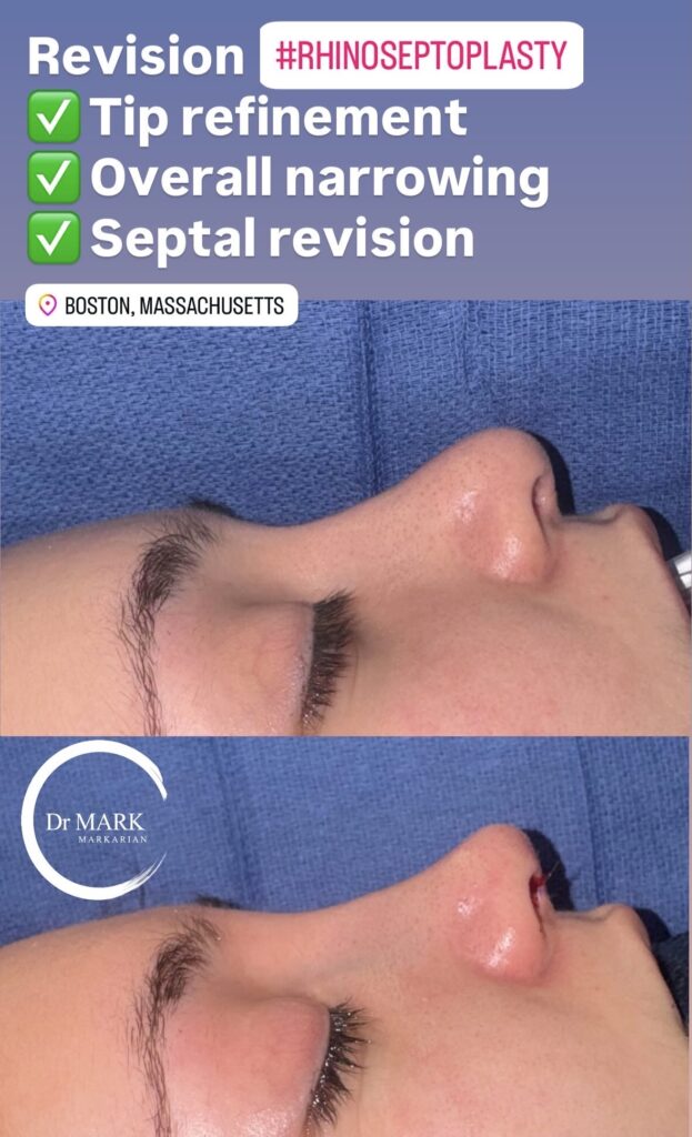 Immediately after a Revision Rhino-Septoplasty