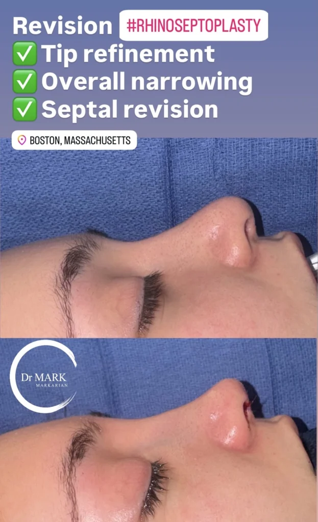Female Rhinoplasty patient result 32