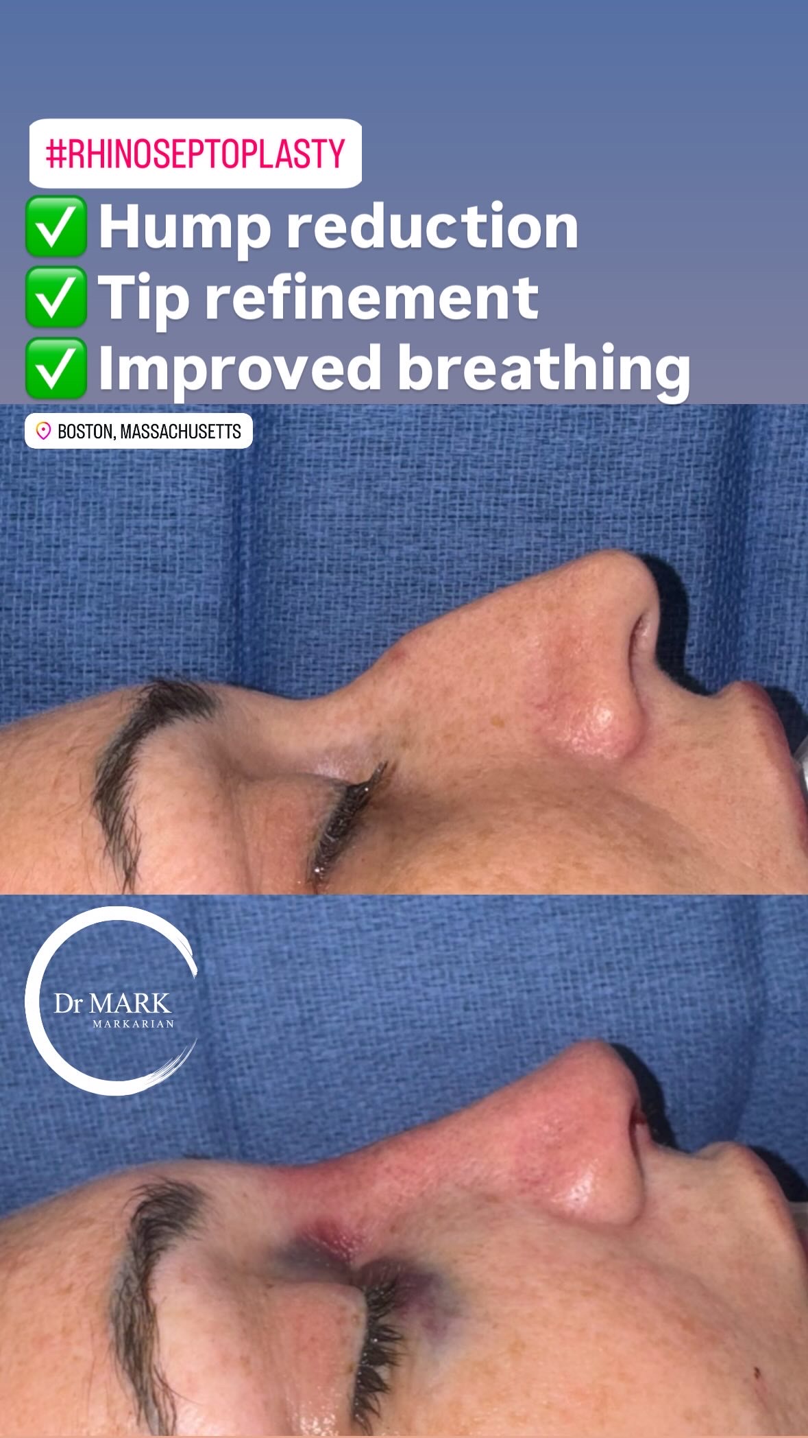 Immediately after a Rhino-Septoplasty showing hump reduction, tip refinement, and improved breathing