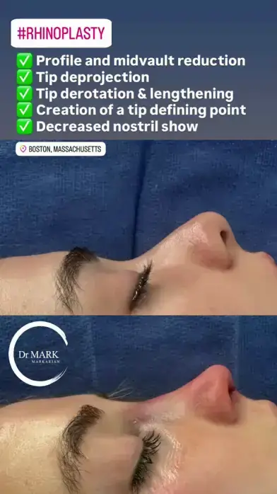 Immediately after a Rhinoplasty showing profile and midvault reduction, tip deprojection, derotation, tip lengthening, and decreased nostril show