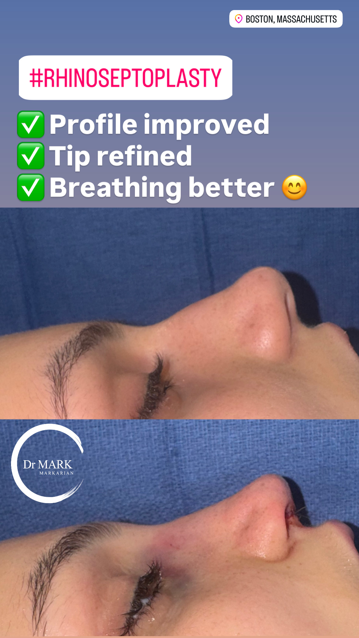 Immediately after a Rhino-Septoplasty showing profile improvement, tip refinement, and improved breathing