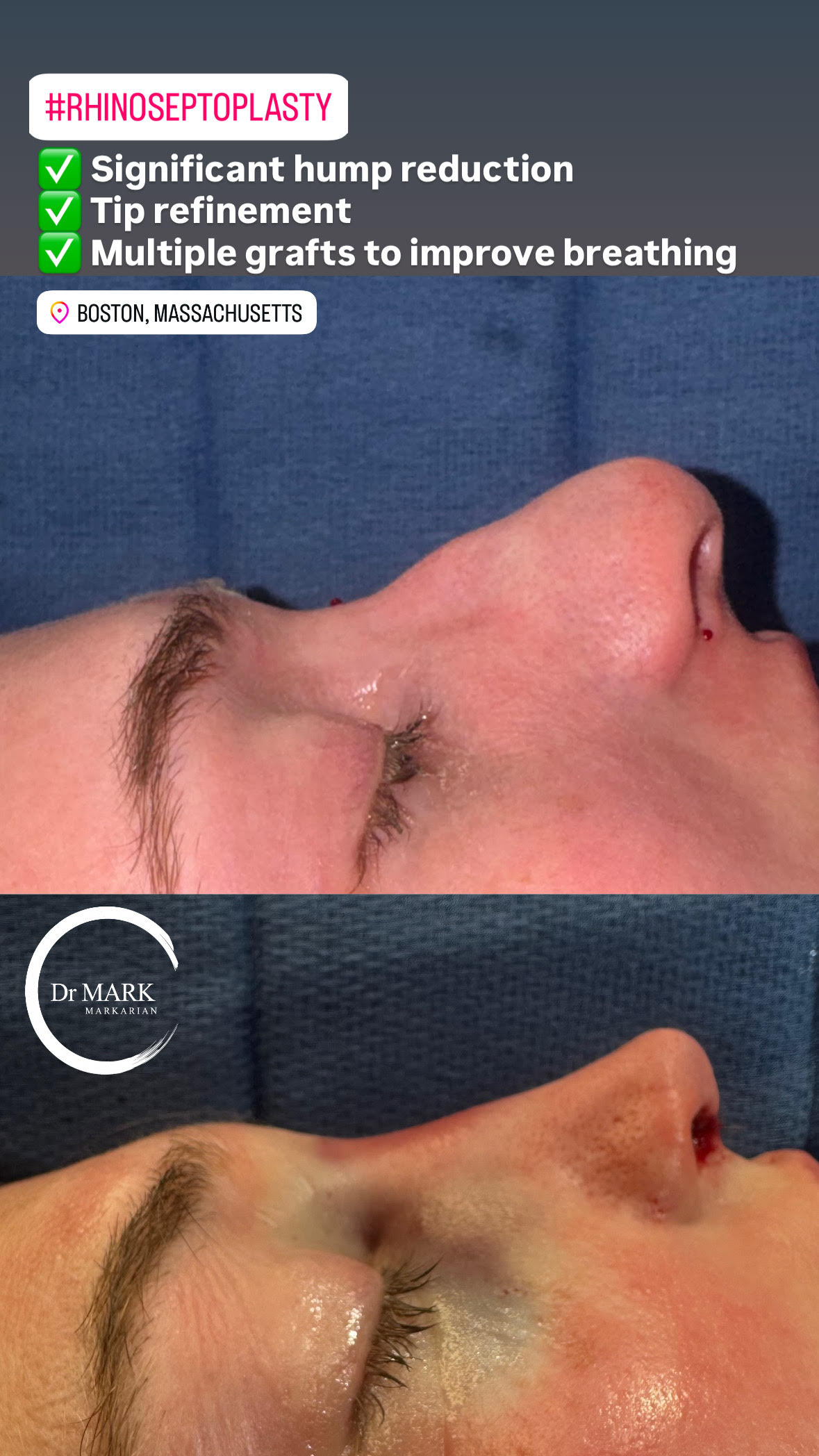 Immediately after a Rhino-Septoplasty showing significant hump reduction, tip refinement, and improved breathing