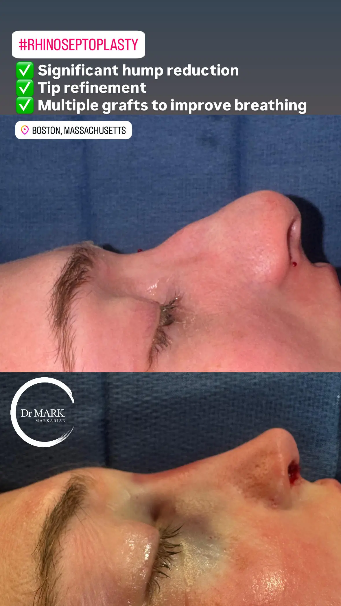 Female Rhinoplasty patient result 29