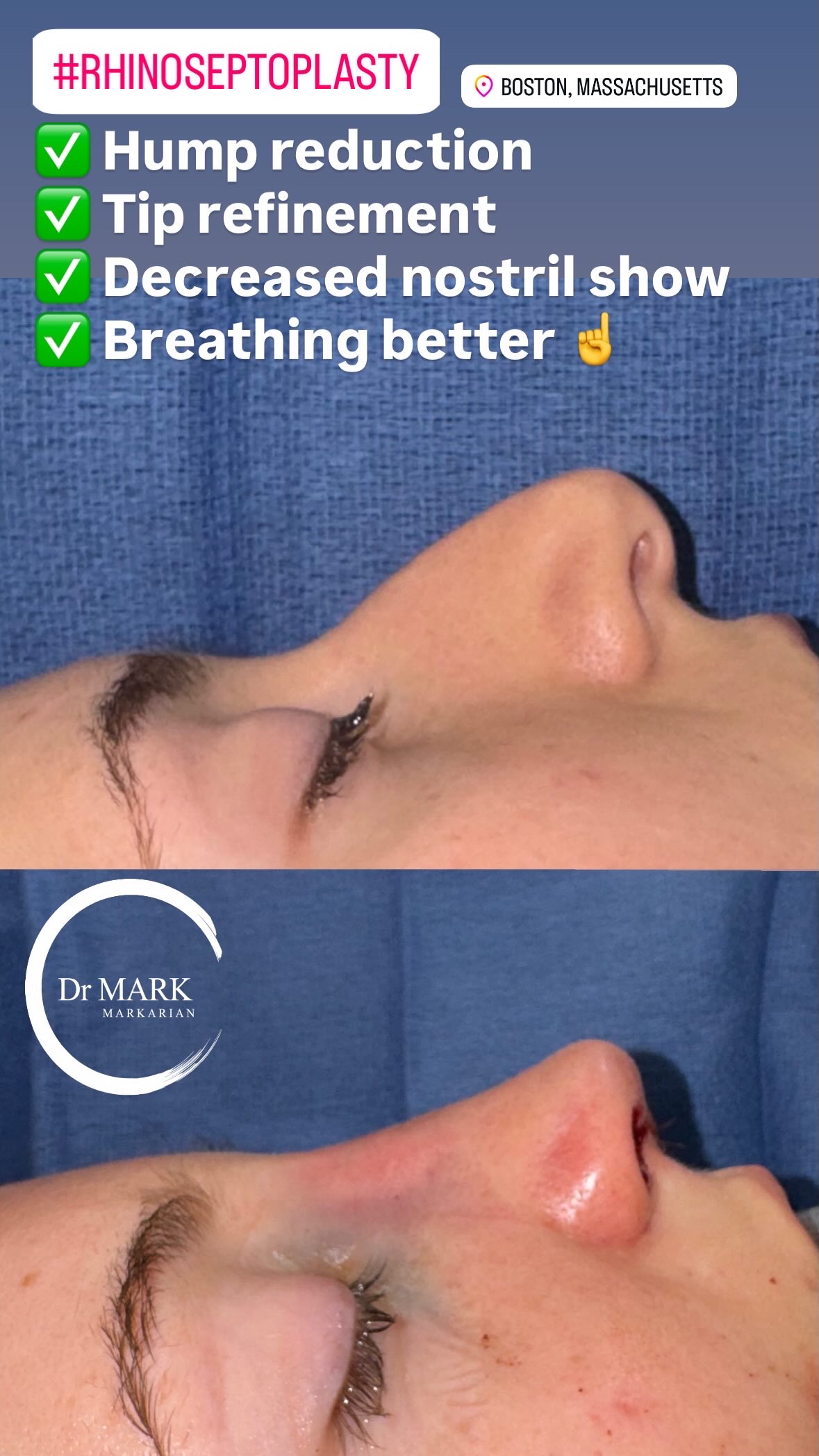Immediately after a Rhino-Septoplasty showing hump reduction, tip refinement, reduced nostril show, and improved breathing