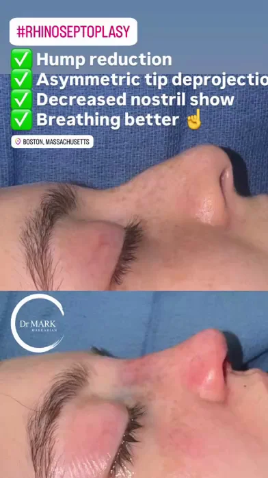 Immediately after a Rhino-Septoplasty showing hump reduction, asymmetric tip deprojection, decreased nostril show, and improved breathing