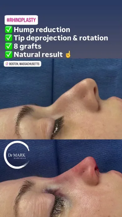 Immediately after a Rhinoplasty showing hump reduction, tip deprojection and rotation