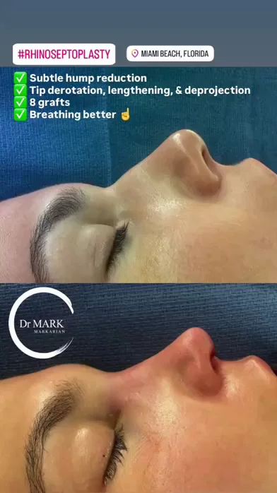 Immediately after a Rhino-Septoplasty showing conservative hump reduction, tip derotation, lengthening, deprojection, and improved breathing
