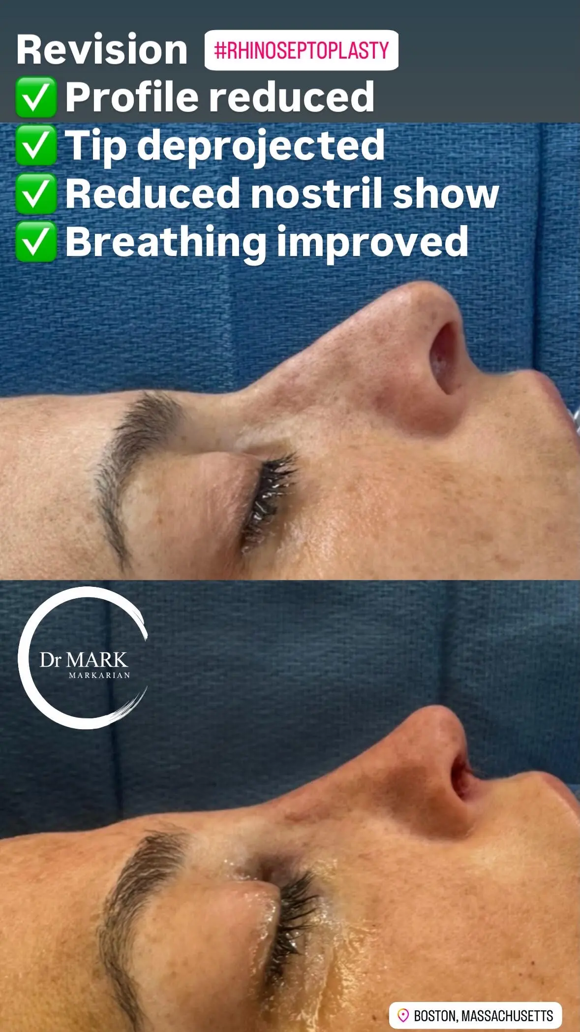 Female Rhinoplasty patient result 23