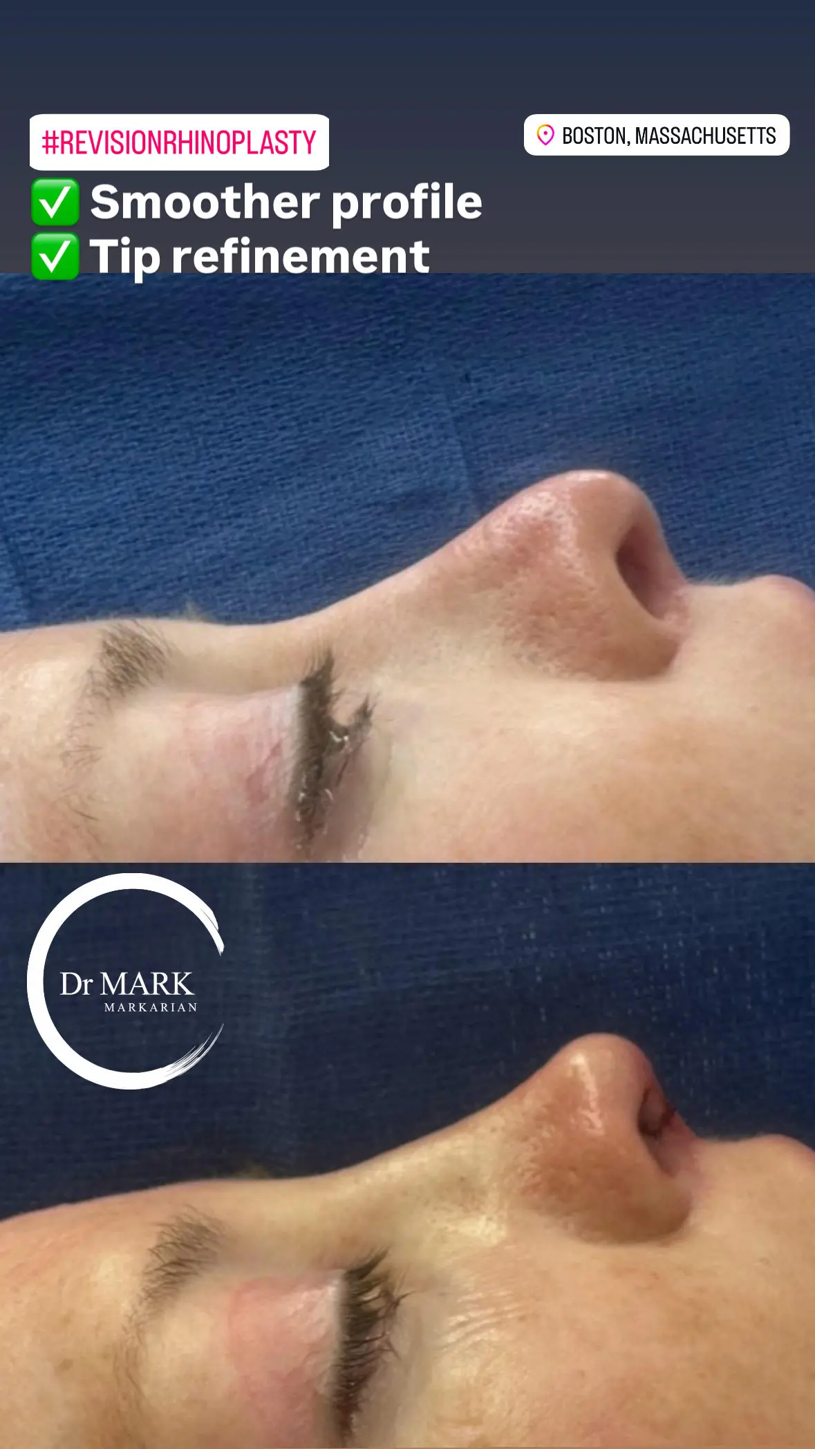 Female Rhinoplasty patient result 22