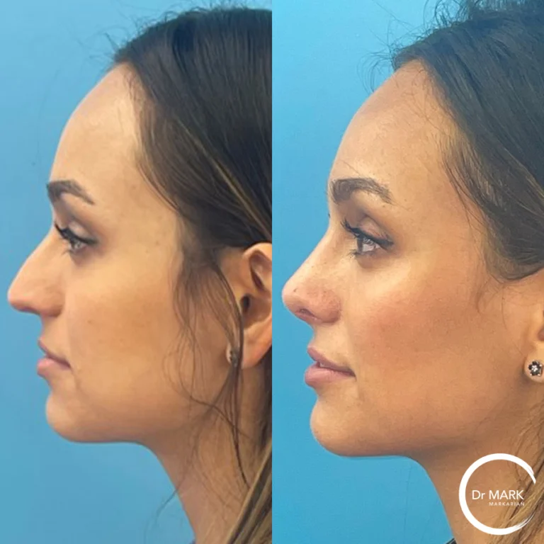Primary rhinoplasty photo 1