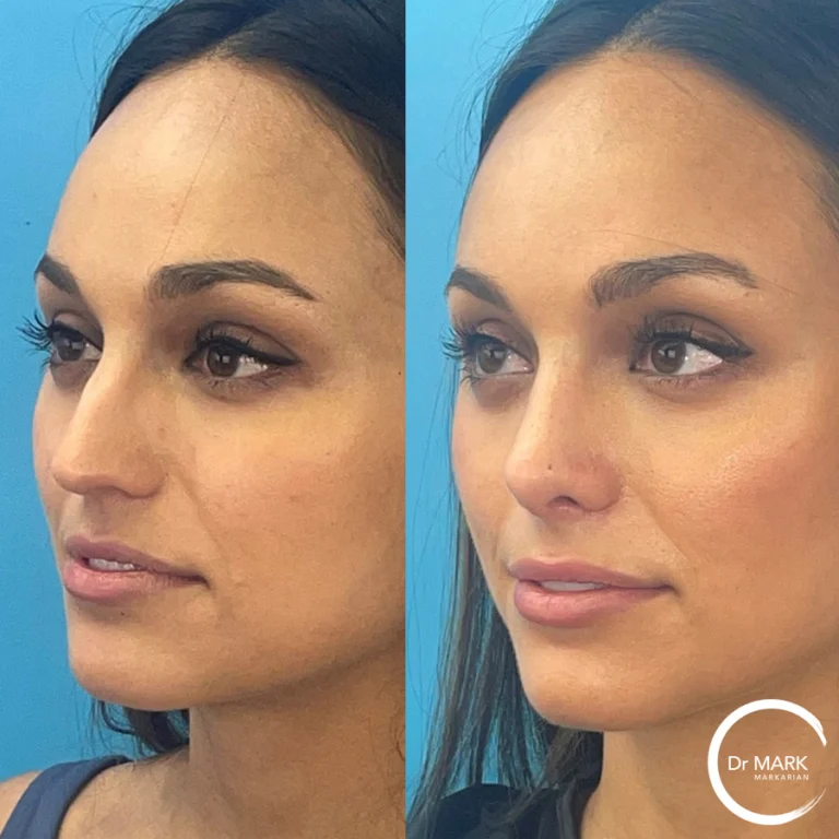 Primary rhinoplasty photo 3