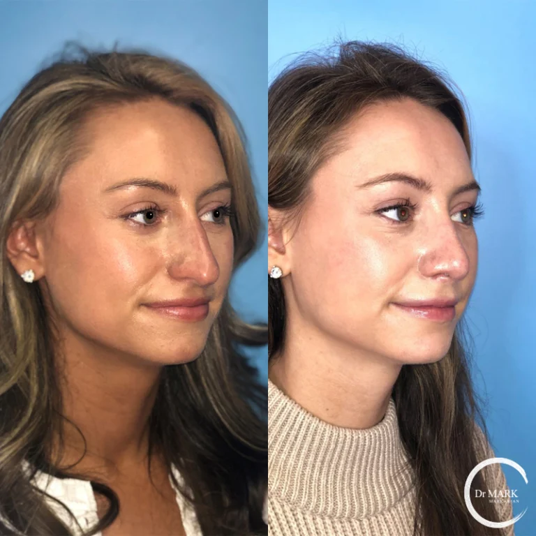Revision rhinoplasty photo 5