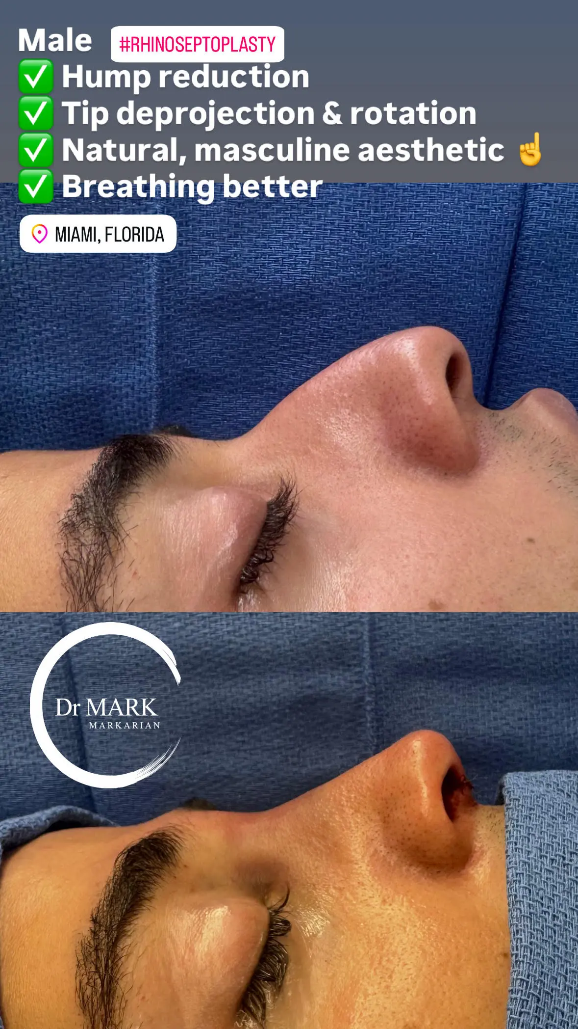 Female Rhinoplasty patient result 18